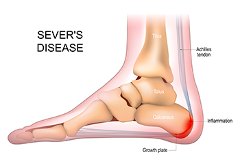 Causes and Impact of Sever s Disease